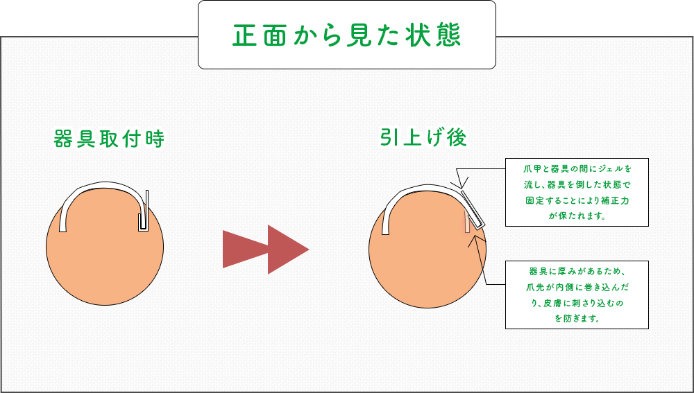 巻き爪